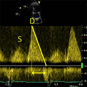 E/A reversal on Doppler echo in LV diastolic dysfunction – All