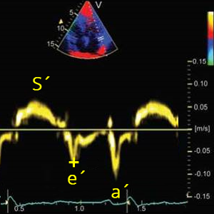 Echocardiography (Diastolic function & dysfunction) - TECHmED