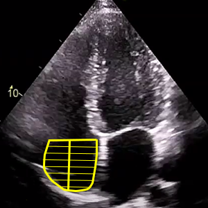 RA volume (Right atrium volume - Single plane)