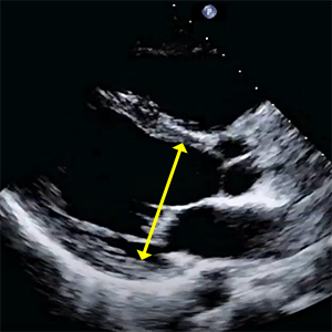 Left Ventricular Mass, Septal and Lateral Wall Thickness