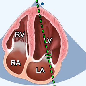 LV diastolic patterns measured by transmitral Doppler of the