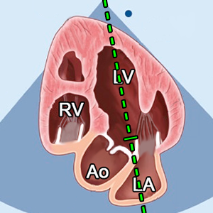 Echocardiography (Diastolic Function & Dysfunction) - TECHmED