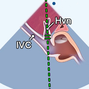 SC window (Hepatic vein) PW doppler of hepatic vein