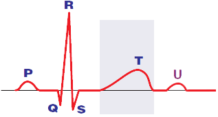 ECG T wave corresponds to phase 3 of the action potential. Represents the repolarization of the ventricles