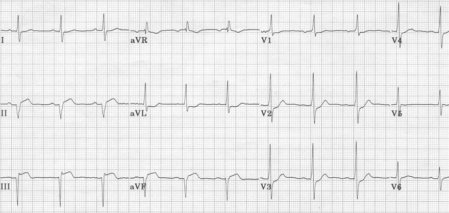 ECG pathological q wave due to prior inferior stemi myocardial infarction