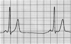 ECG delta wave, WPW syndrome, short PR interval