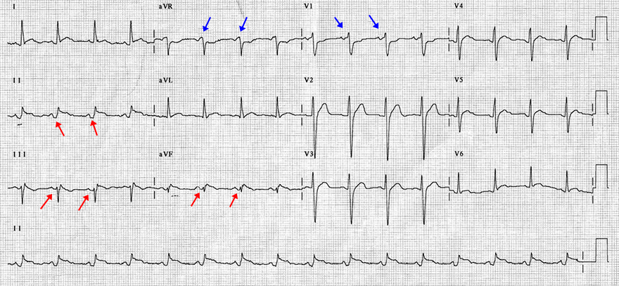 ECG inferior STEMI and atrial ischaemia (infarction). PR elevation (aVR, V1), PR depression (II, III, aVF)