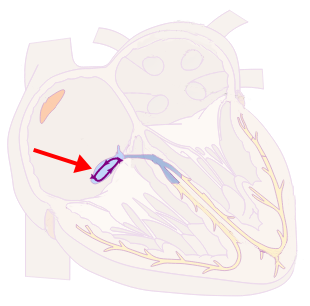 AV nodal reentrant tachycardia (AVNRT)