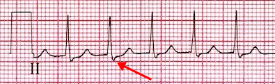 ECG Pseudo S wave, inferior leads (II, III, aVF), AV Nodal Re-entry Tachycardia (AVNRT)