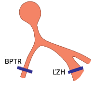 Bifascicular block, left posterior fascicular block (LPFB), complete right bundle branch block (RBBB) 