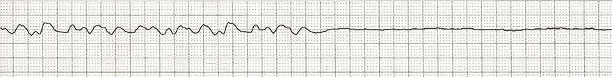 ECG fine ventricular fibrillation and asystole