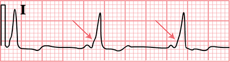 ECG WPW syndrome, sinus rhythm, delta wave, Short PR, QRS prolongation 