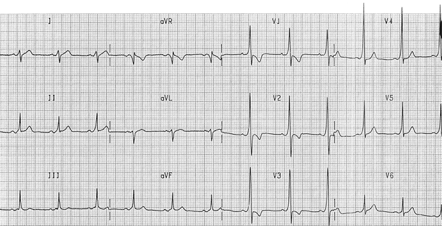 ECG wpw syndrome, Type A, delta wave, dominant R wave in V1