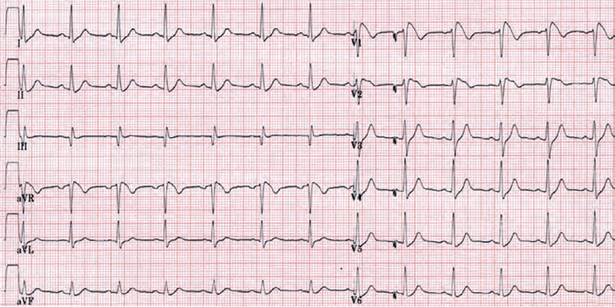 ECG pattern Brugada syndrome type 1