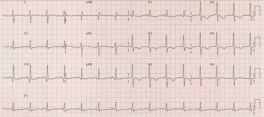 ECG acute pulmonary embolism, right axis deviation, Clockwise (CW) rotation, S1Q3T3, negative T wave