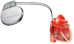 Pacemaker dual chamber leads (atrial, ventricular)