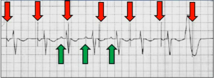 ECG pacemaker AOO mode