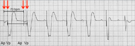 ECG pacemaker DDI pacing mode