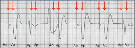 ECG pacemaker DOO pacing mode