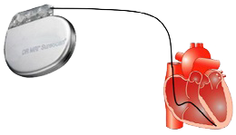 Pacemaker single chamber mode (ventricular lead)
