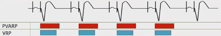 ECG pacemaker DDD mode, PVARP (Post ventricular atrial refractory period), VRP (Ventricular refractory period)