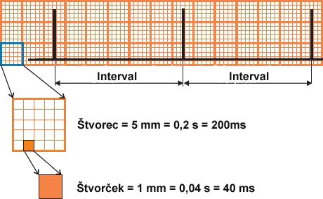 ECG pacemaker interval, large square, small square