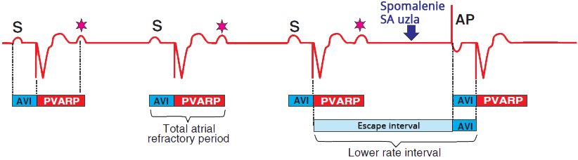 Pacemaker uppper rete response: URI = AVI + PVARP, Fixed-ratio block 2:1