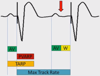 ECG pacemaker wenckebach upper rate response, URI (upper rate interval) is longer than TARP (total atrial refractory period)