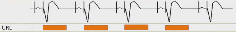 ECG pacemaker URL (upper rate limit), maximum tracking rate (MTR)