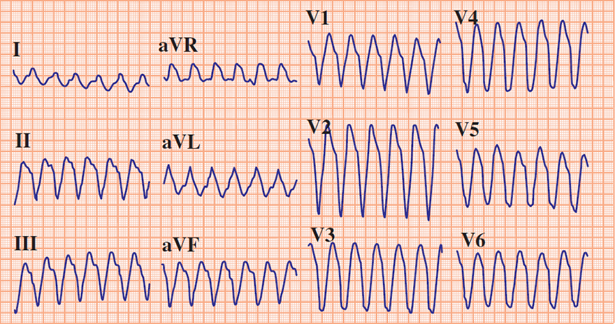 ECG Brugada algorithm, RS complex in all precordial leads (NO) - Ventricular tachycardia