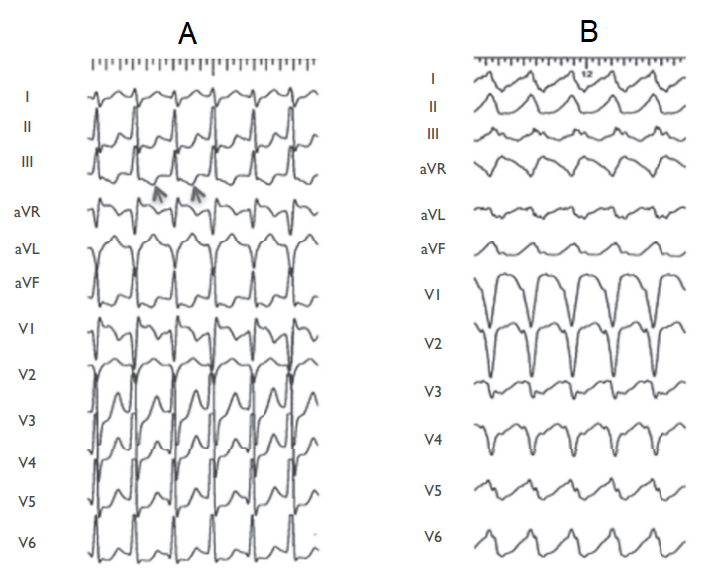 ekg avrt